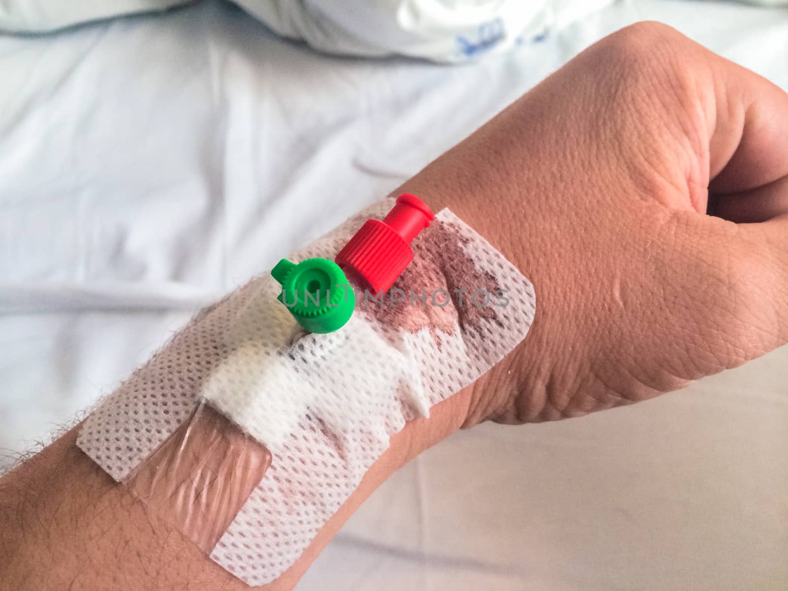 Intravenous cannula, venflon inserted on man's hand with bloodstain.