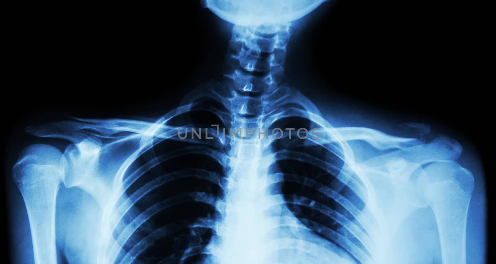 Film x-ray both clavicle AP ( front view ) : show fracture distal left clavicle