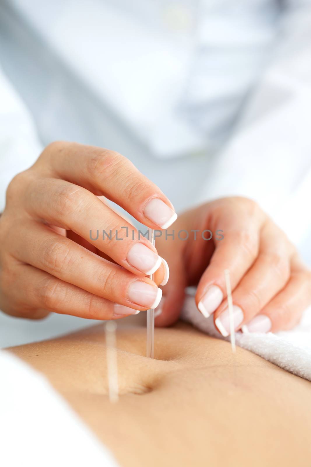 Doctor applying acupuncture on a patient's abdomen