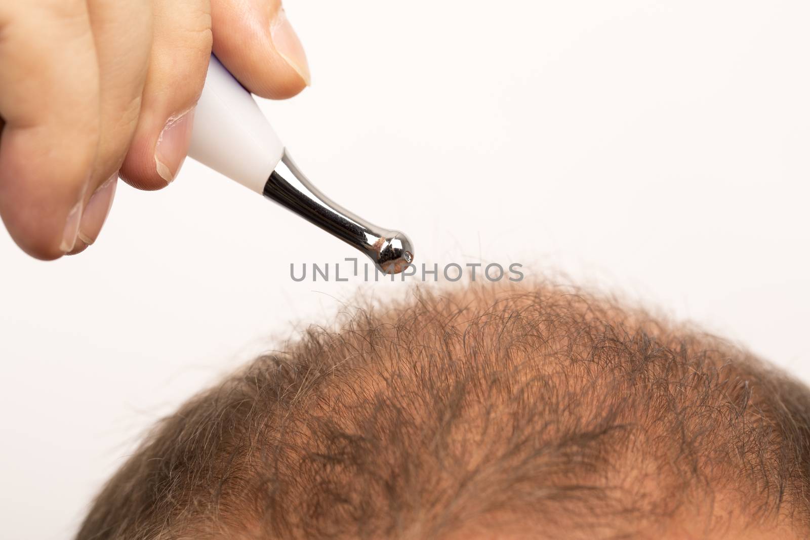 Baldness Alopecia man hair loss isolated by CatherineL-Prod