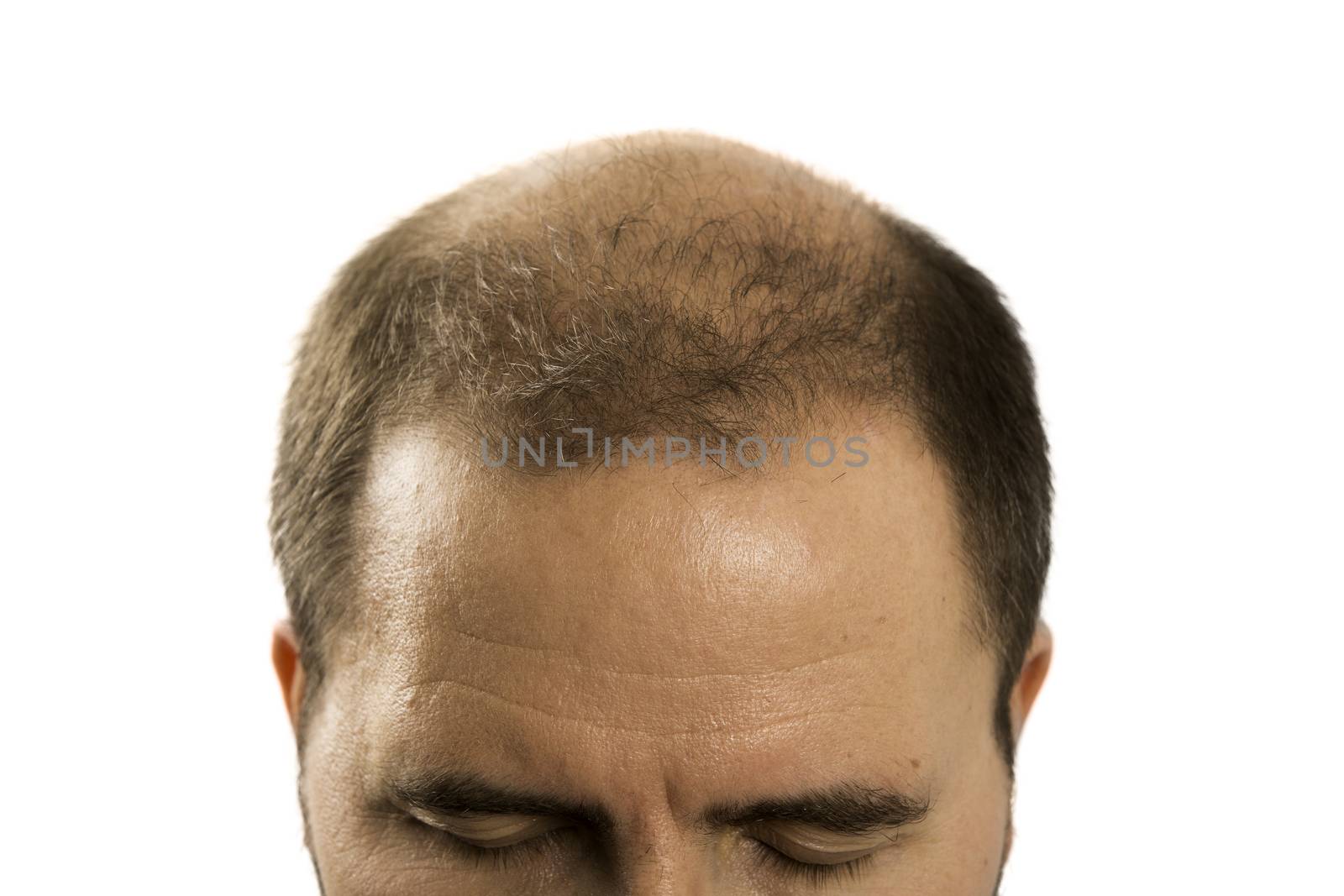 Baldness Alopecia man hair loss isolated by CatherineL-Prod