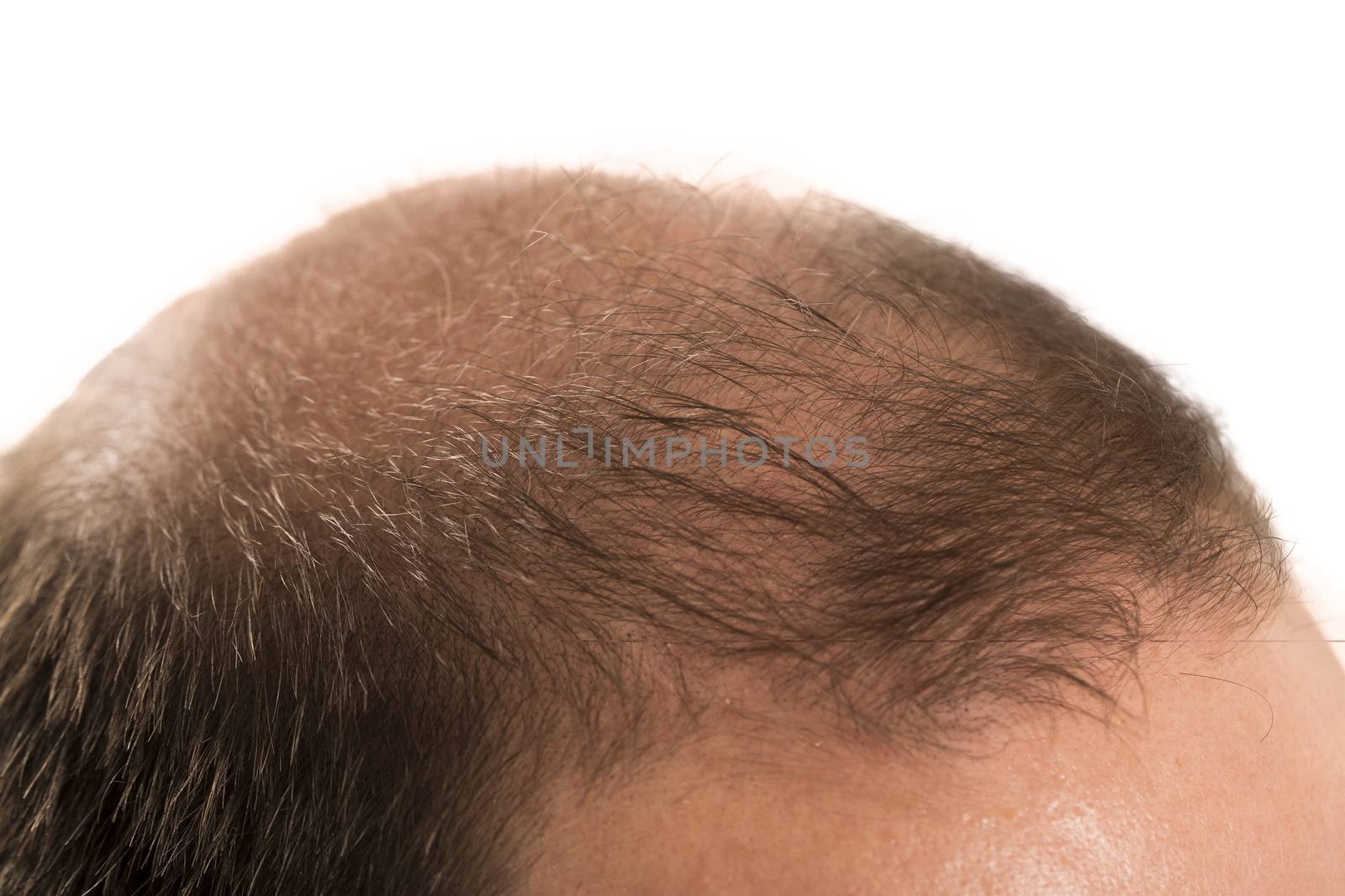 Baldness Alopecia man hair loss isolated by CatherineL-Prod
