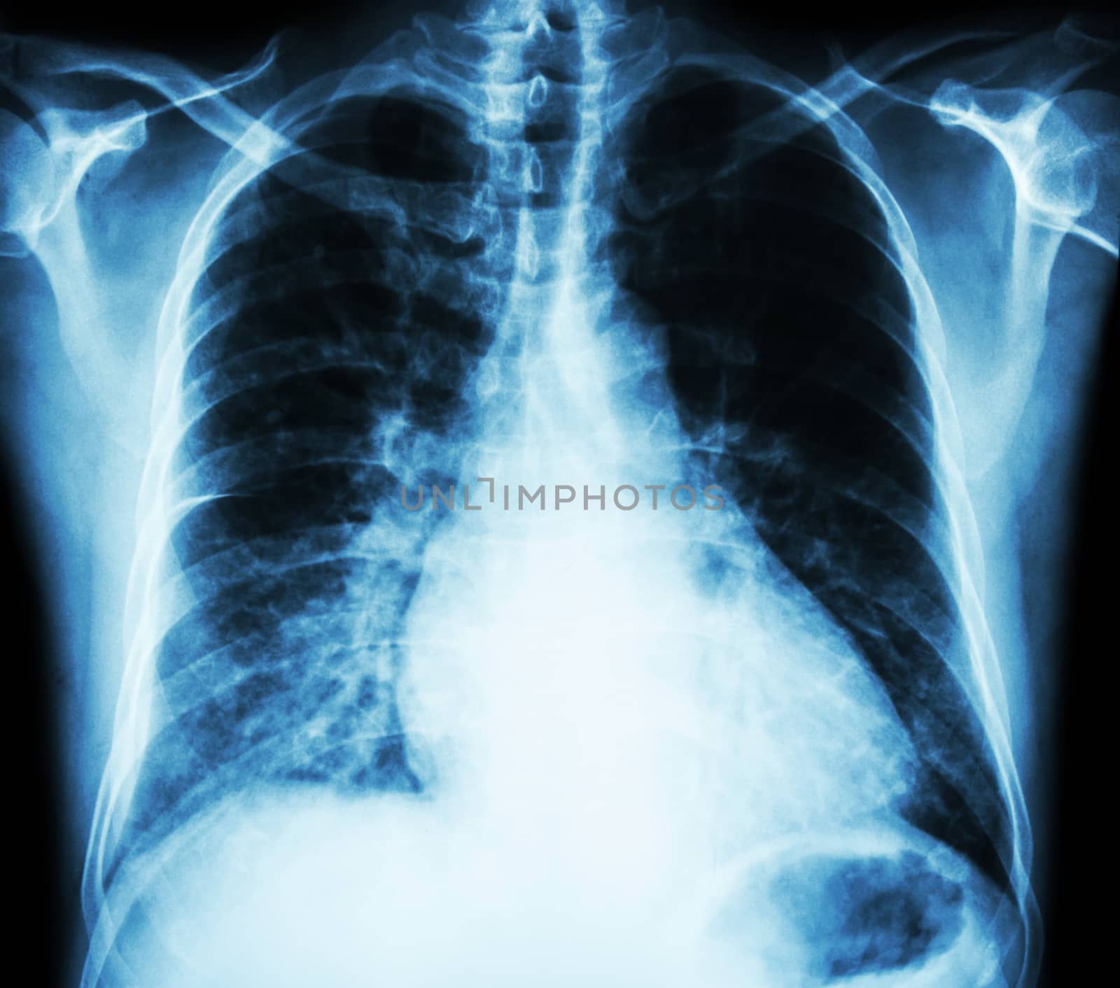 Heart failure ( film x-ray chest PA upright : show cardiomegaly and interstitial infiltrate both lung )