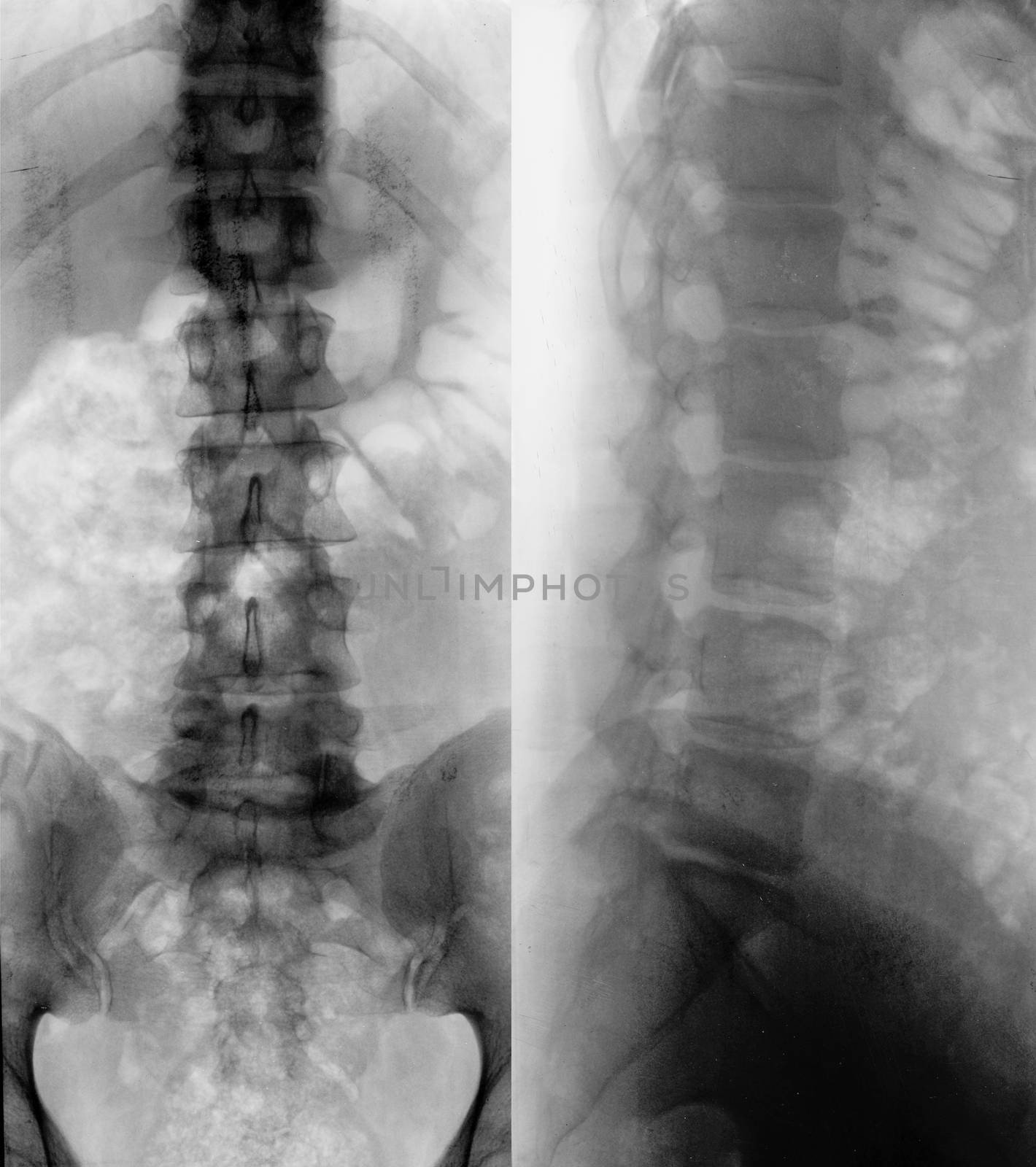X-ray black and white shot of a male spine showing scliosis