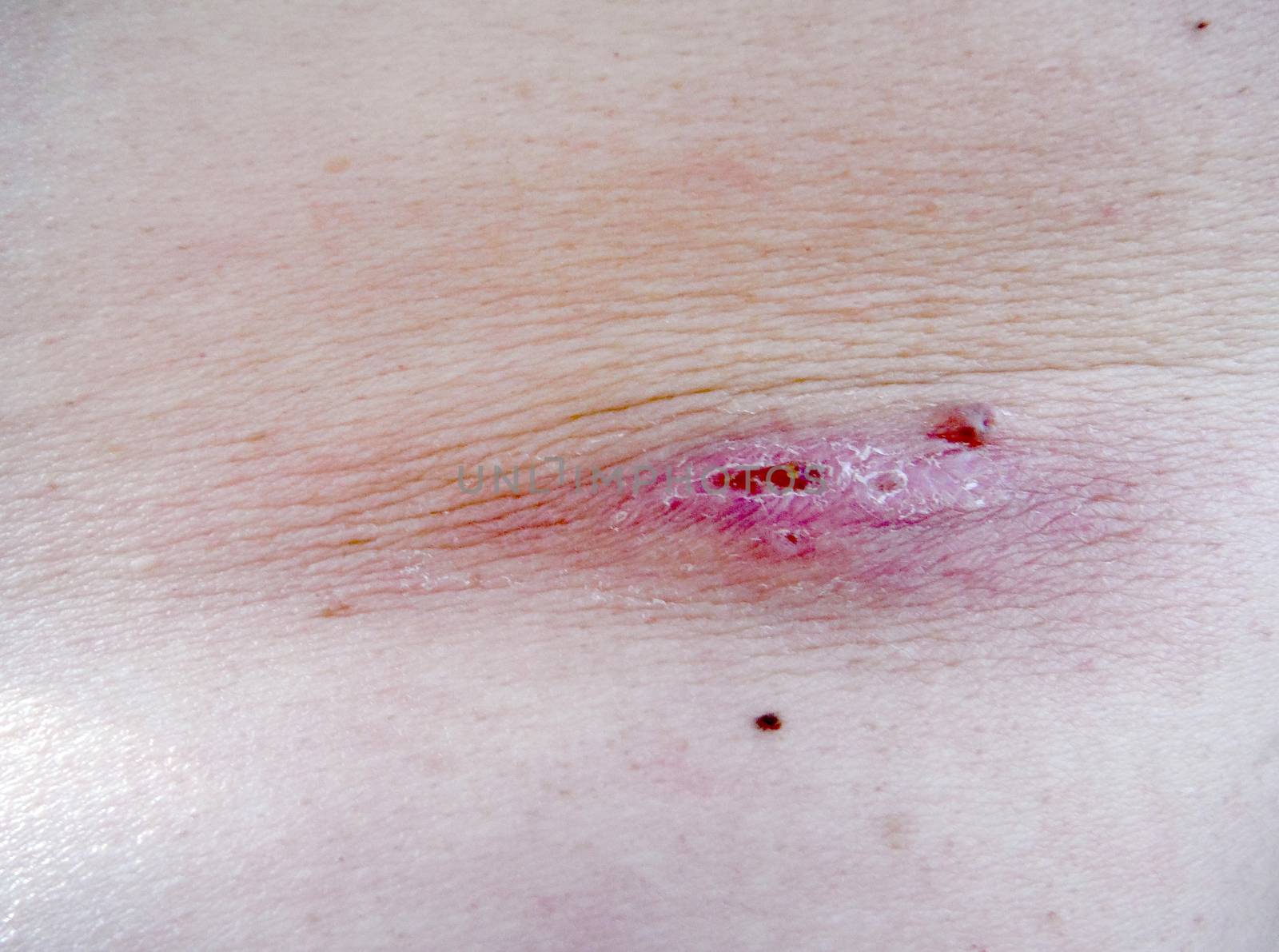 Pimple Extreme Macro on an adult man skin