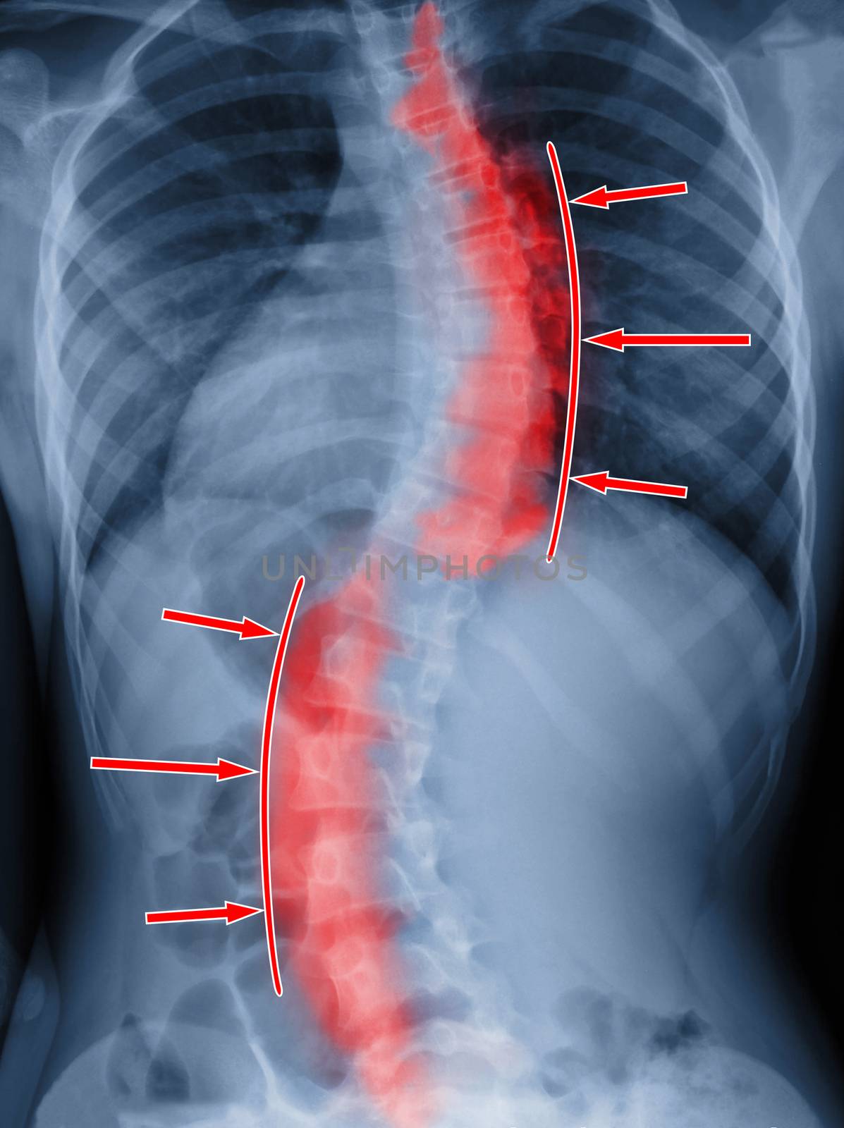 Scoliosis film x-ray show spinal bend in teenager patient. Treatment concept