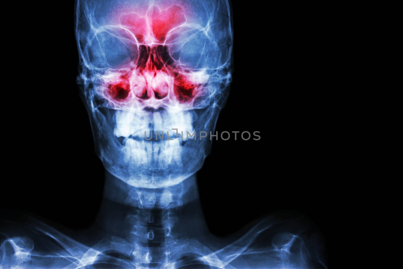 Sinusitis. film x-ray skull AP ( anterior - posterior ) show infection and inflammation at frontal sinus , ethmoid sinus , maxillary sinus and blank area at right side