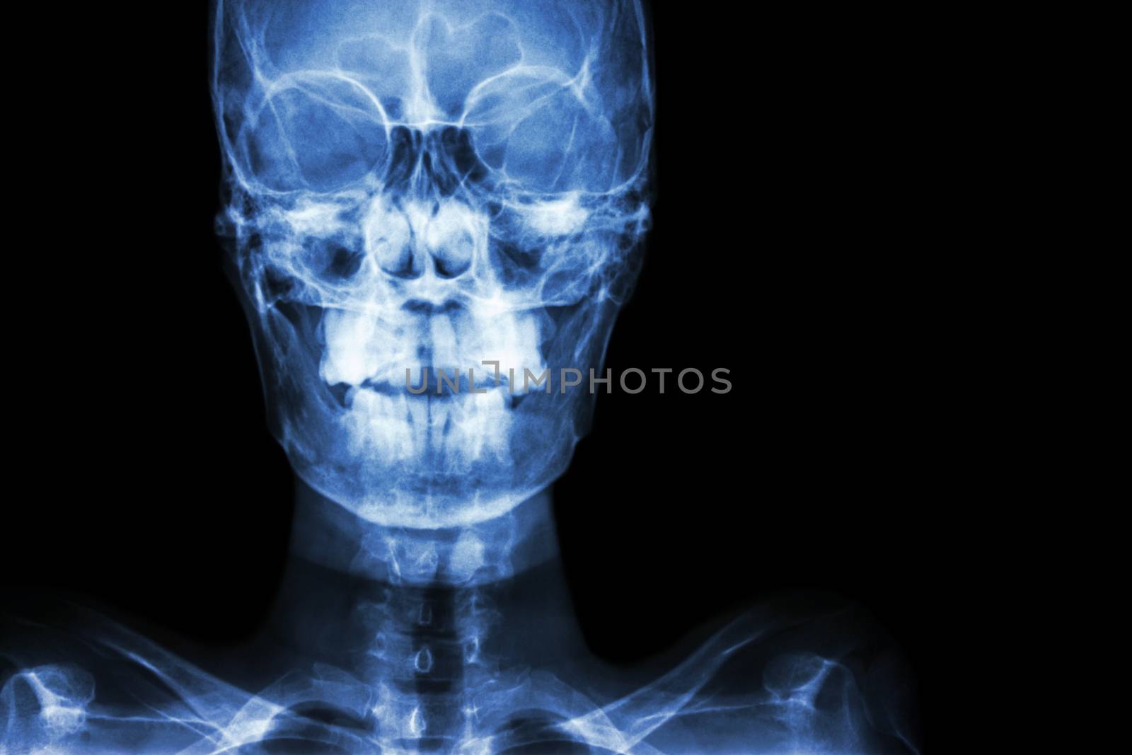 film x-ray Skull AP : show normal human's skull and blank area at right side