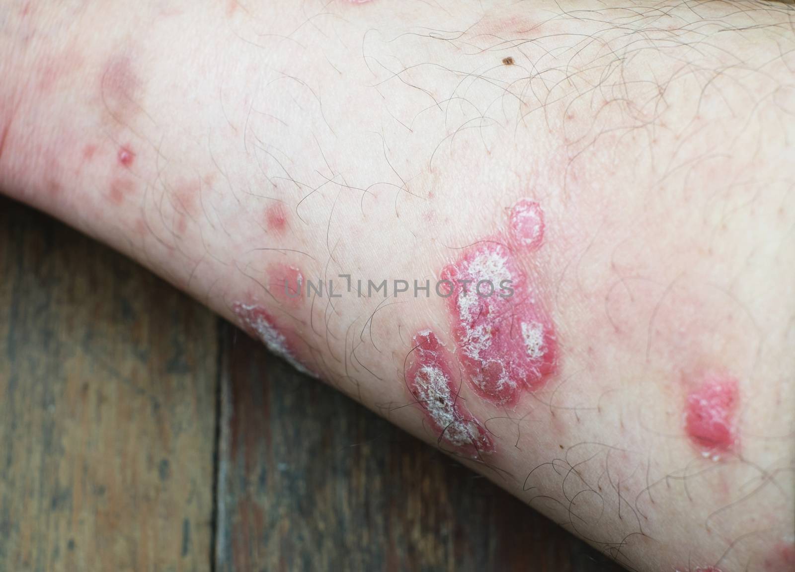 Psoriasis by baworn47