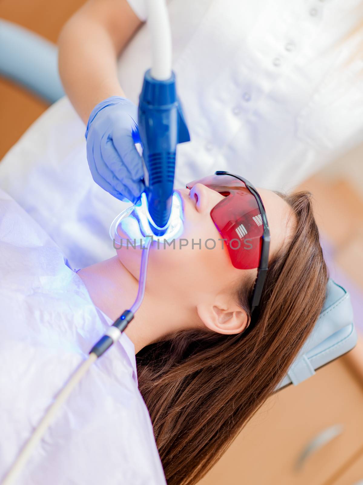Laser Teeth Whitening by MilanMarkovic78