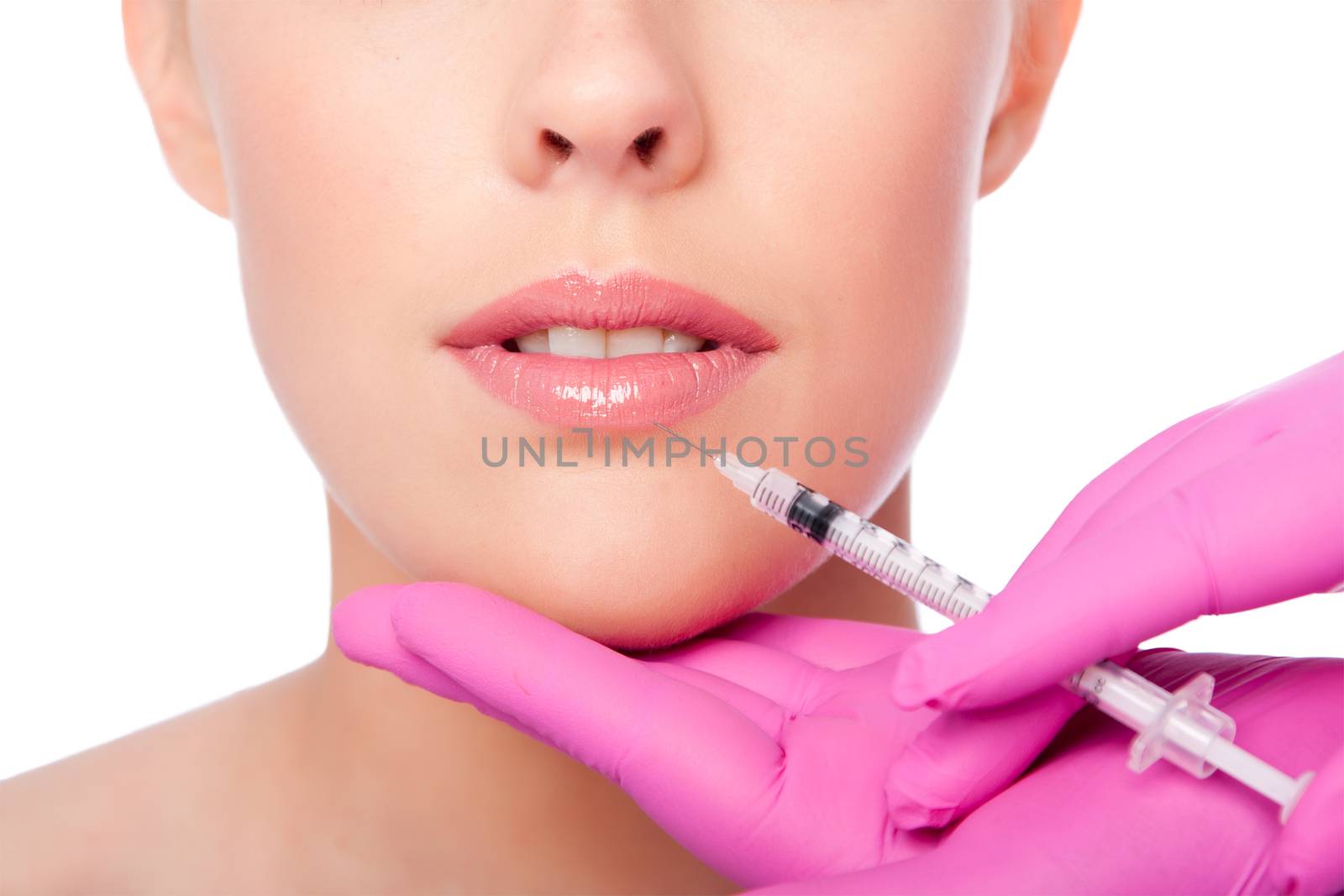 Beauty lip collagen filler injection by phakimata