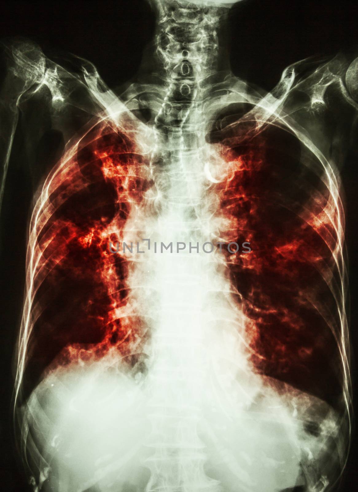 Pulmonary Tuberculosis . film chest x-ray of old patient show interstitial infiltration both lung and calcification at trachea ( can seen shape of trachea )