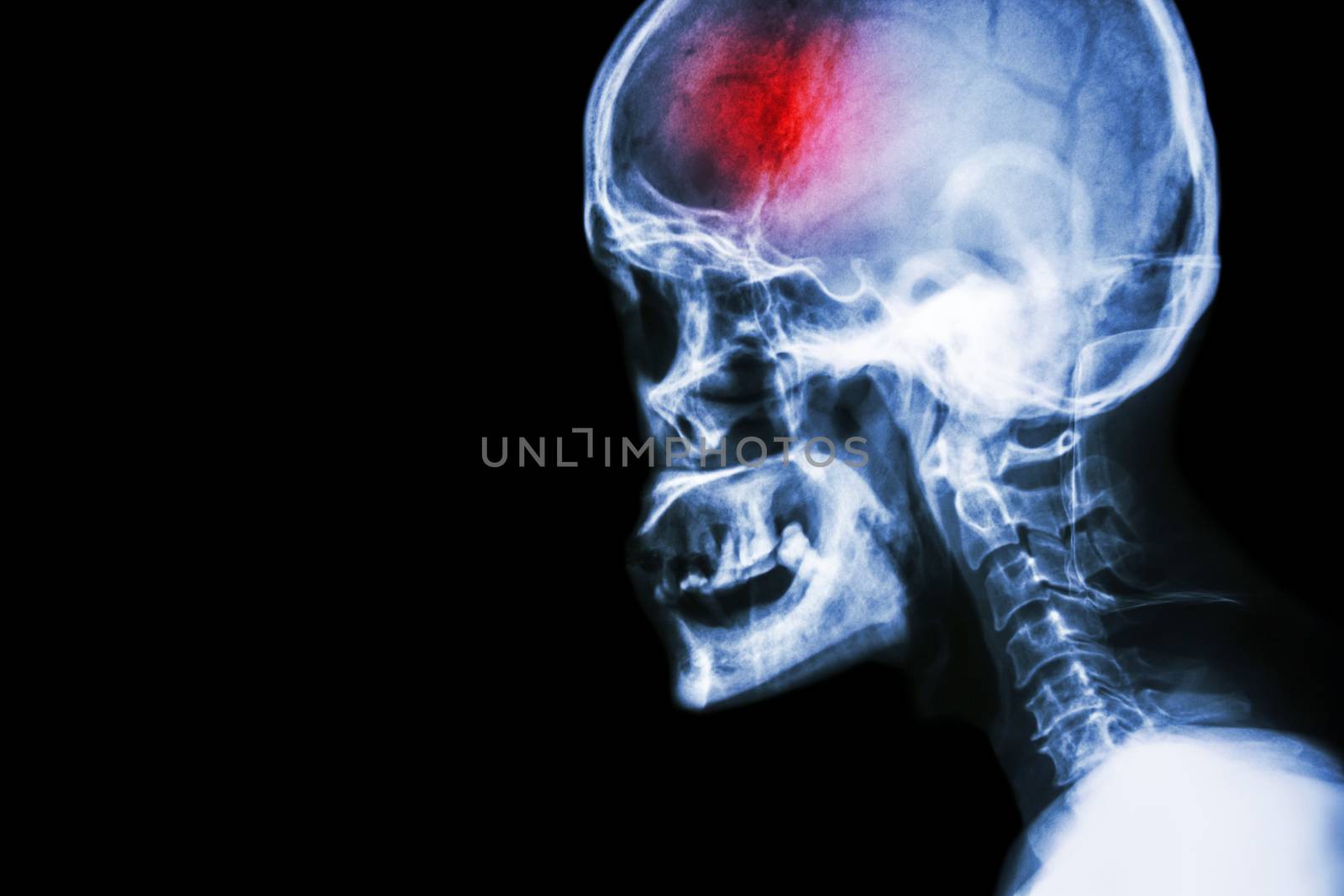 Stroke . film x-ray skull and cervical spine lateral view and stroke . cerebrovascular accident . blank area at left side .