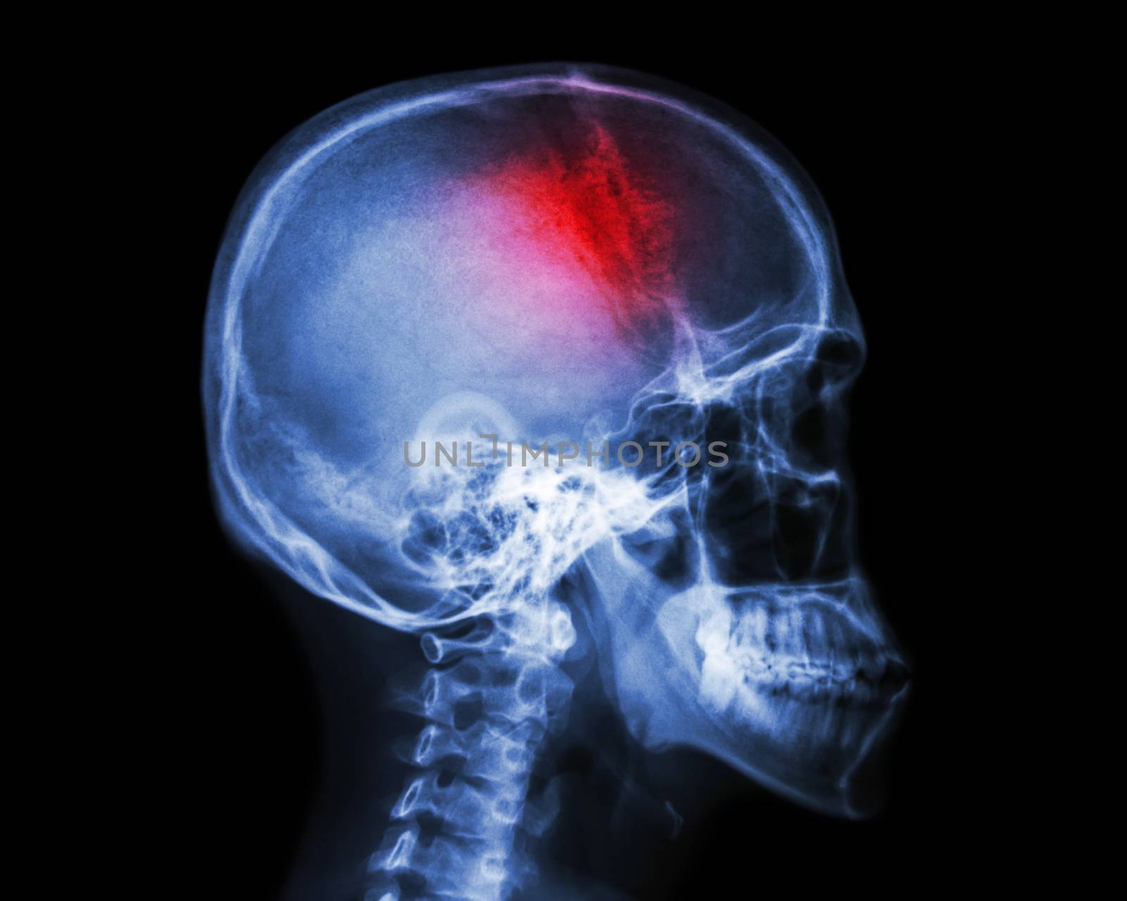 Stroke . film x-ray skull lateral view show human skull and stroke . cerebrovascular accident . isolated background by stockdevil