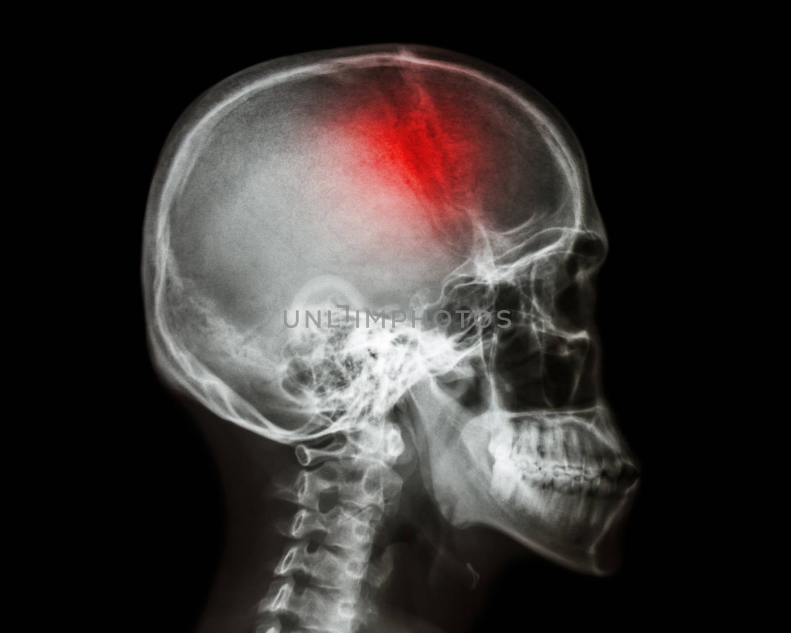 Stroke . film x-ray skull lateral view show human skull and stroke . cerebrovascular accident . isolated background by stockdevil