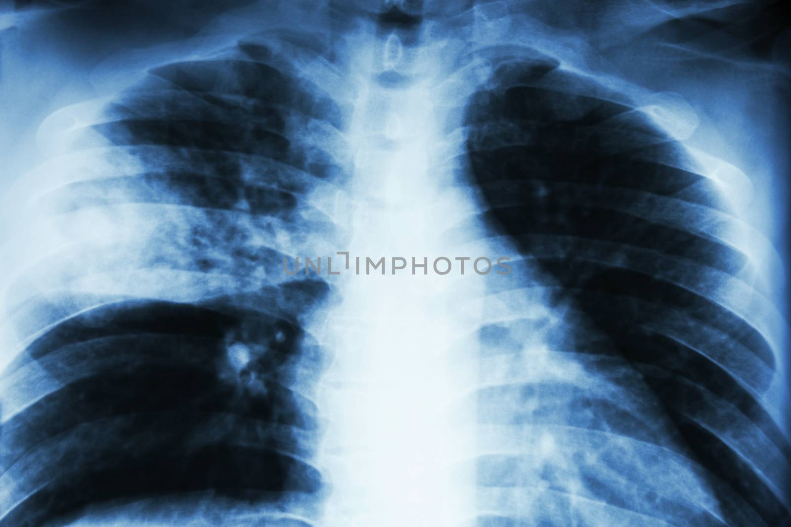Lobar pneumonia . film chest x-ray show alveolar infiltration at right middle lobe due to tuberculosis infection . by stockdevil