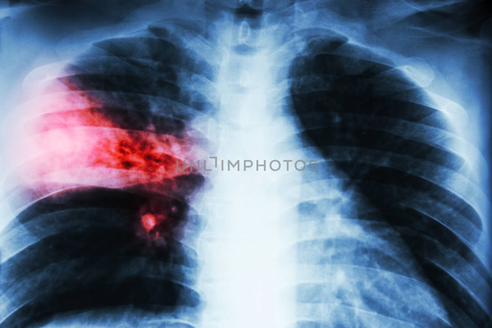 Lobar pneumonia . film chest x-ray show alveolar infiltration at right middle lobe due to tuberculosis infection . by stockdevil