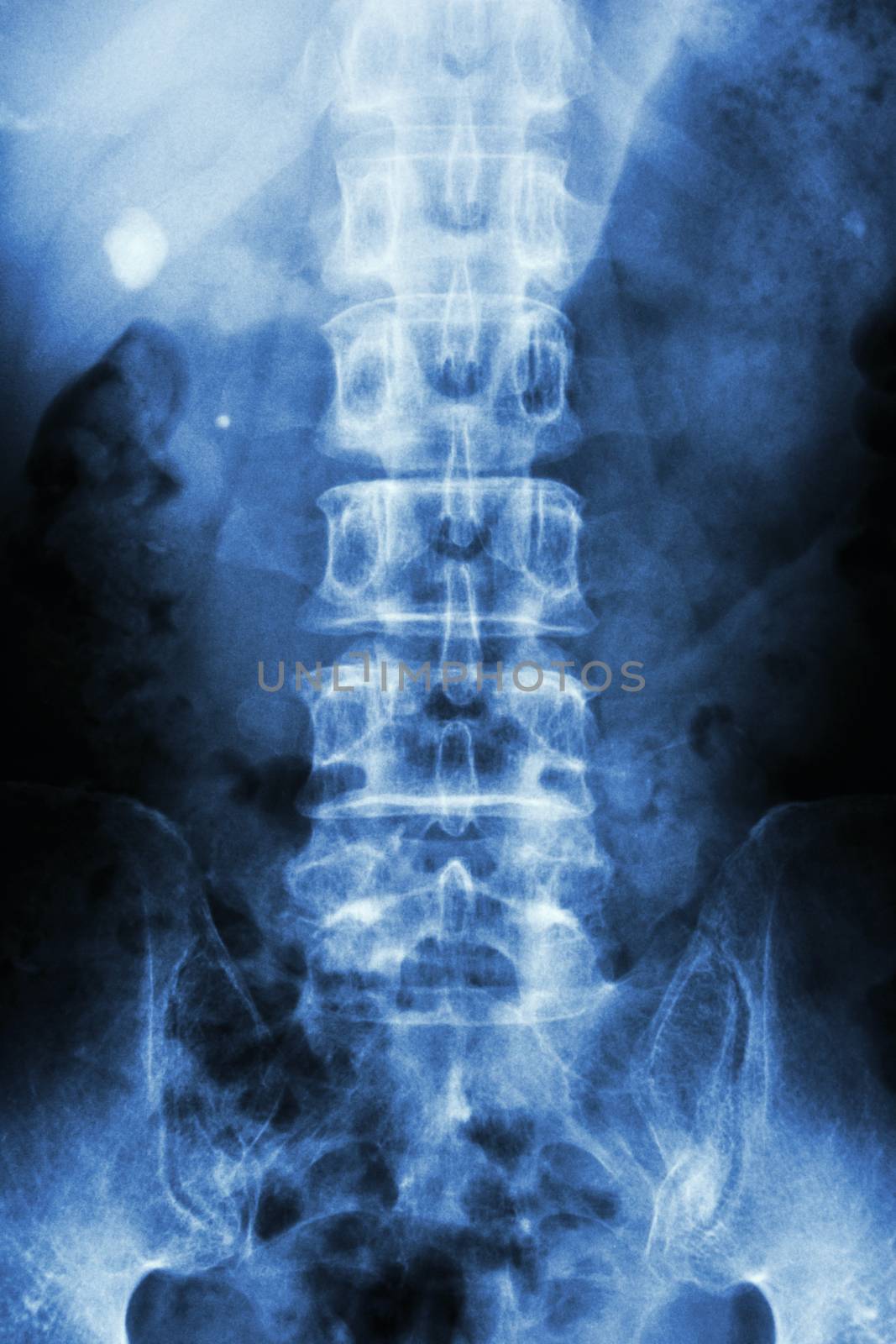 film x-ray KUB ( Kidney - ureter - bladder ) show right renal stone ( round shape at left side )