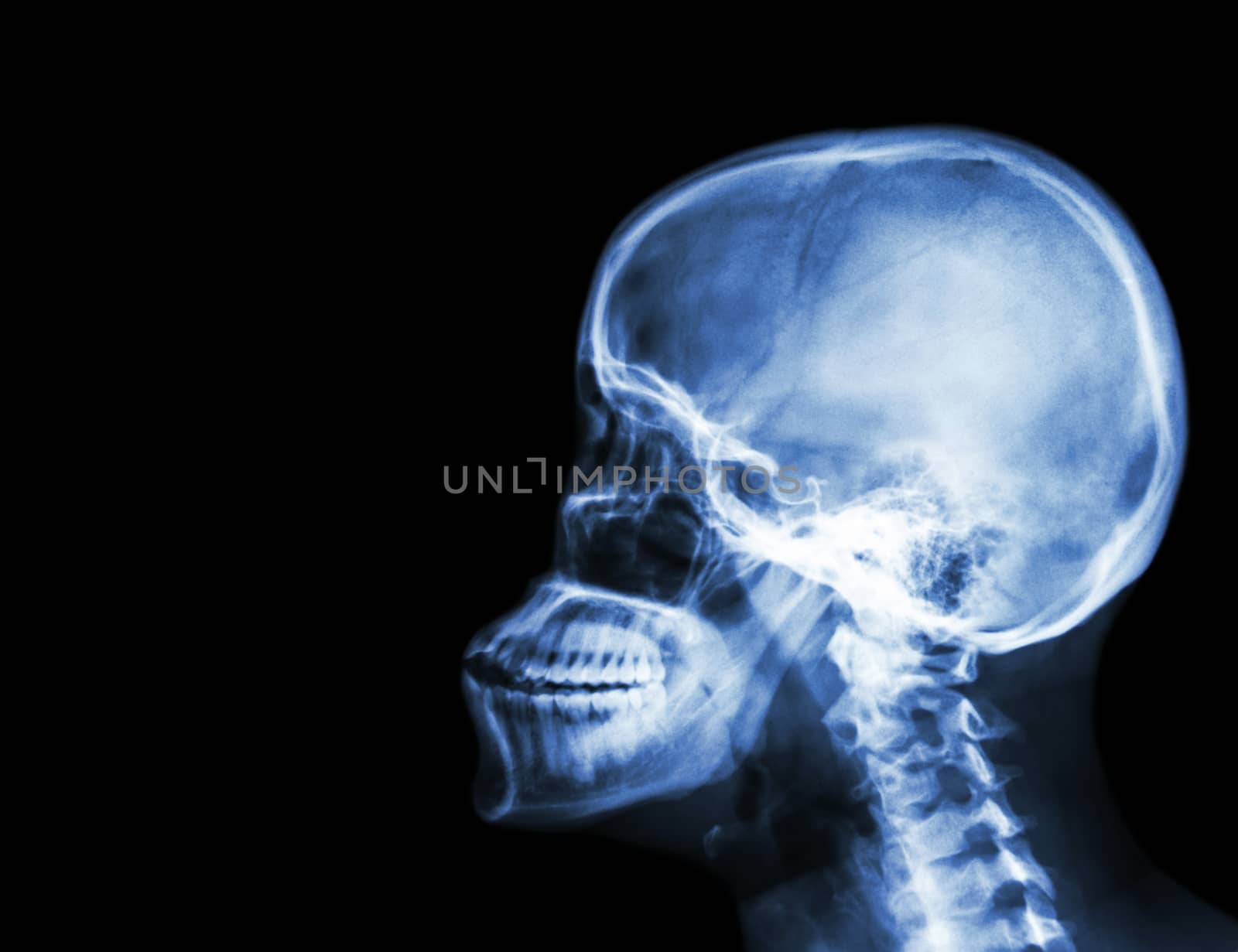 Film x-ray skull and cervical spine lateral view . blank area at left side by stockdevil
