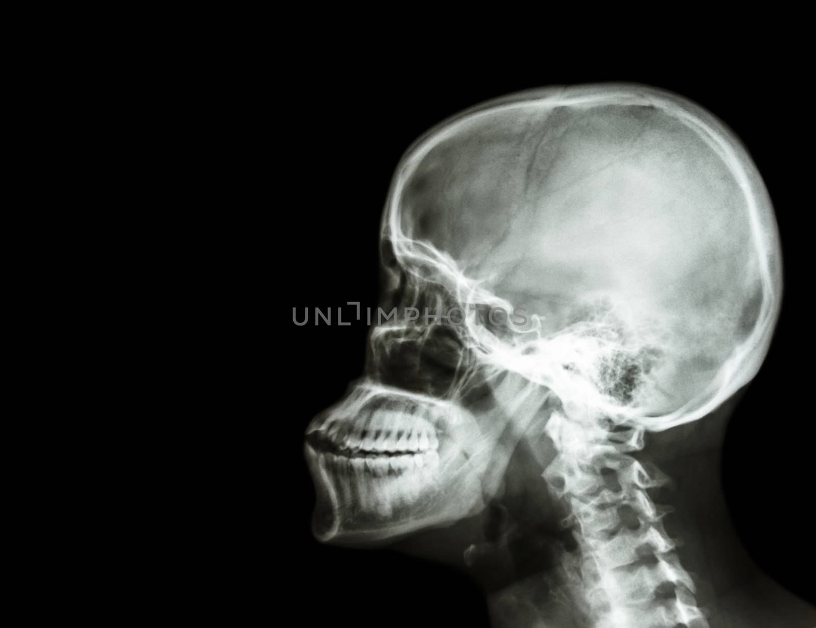Film x-ray skull and cervical spine lateral view . blank area at left side