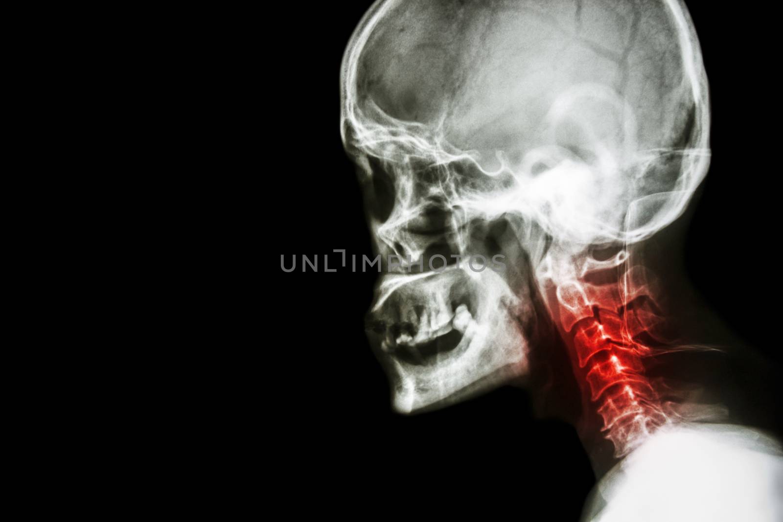 Cervical spondylosis . film x-ray skull lateral view and neck pain . by stockdevil