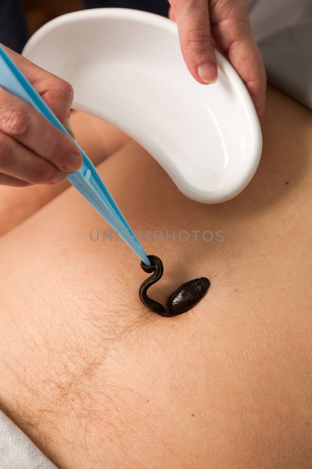 the doctor puts a leech tweezers on a stomach of the person