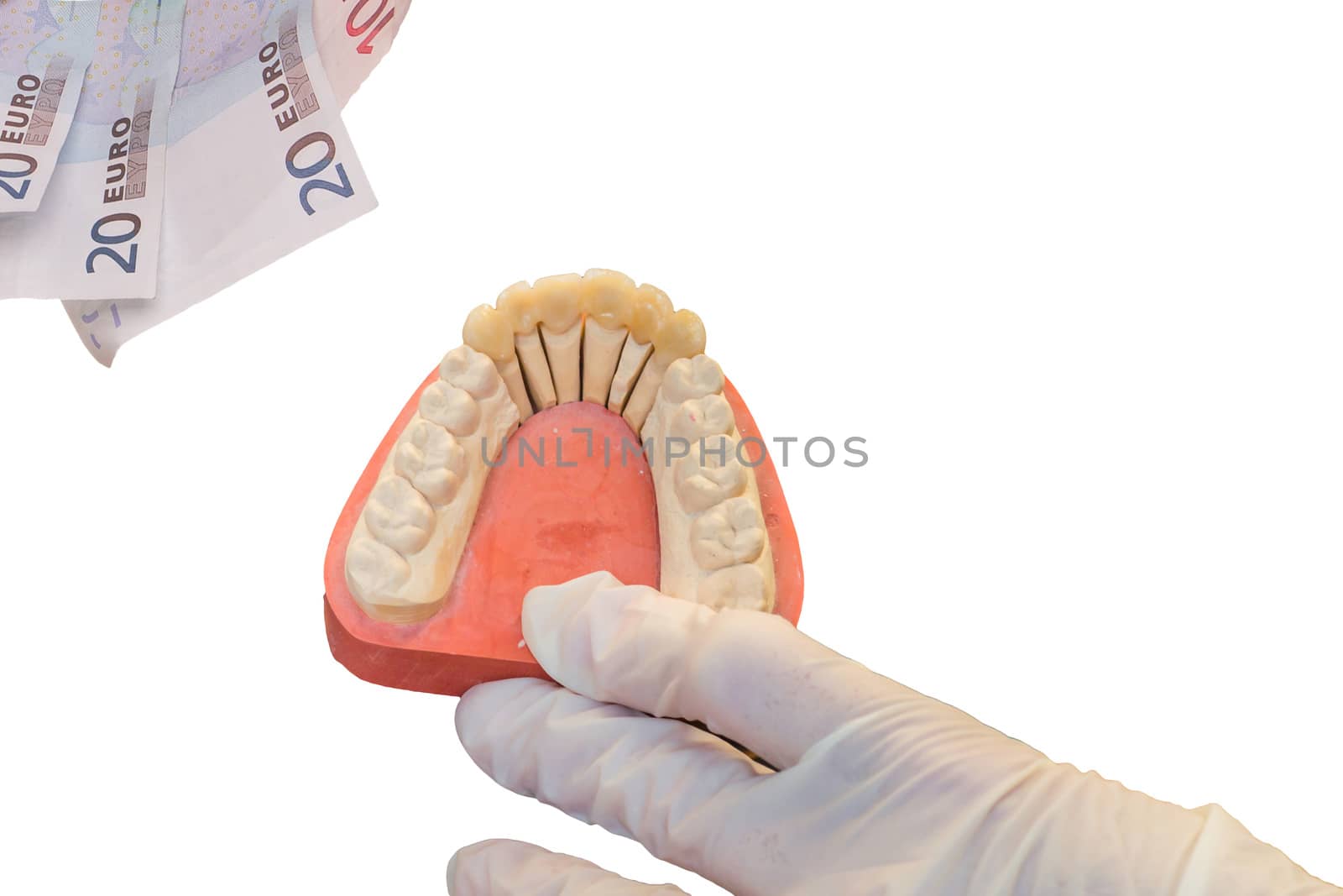 Denture and euro bills, a focus on the artificial teeth. Symbol of high dentures cost.