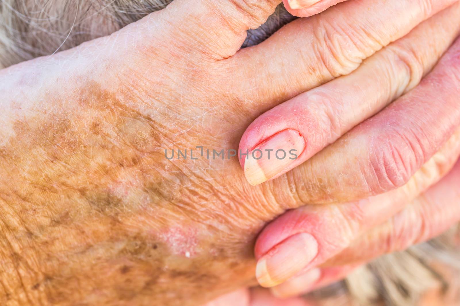 hands of an elderly woman with eczema or allergic skin problems