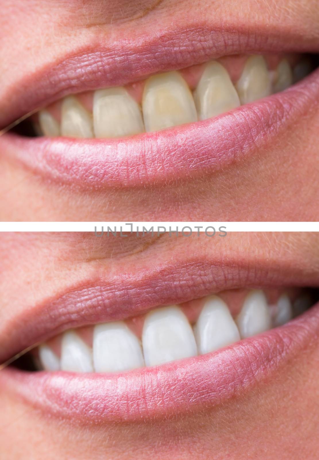 woman teeth before and after whitening by pixinoo