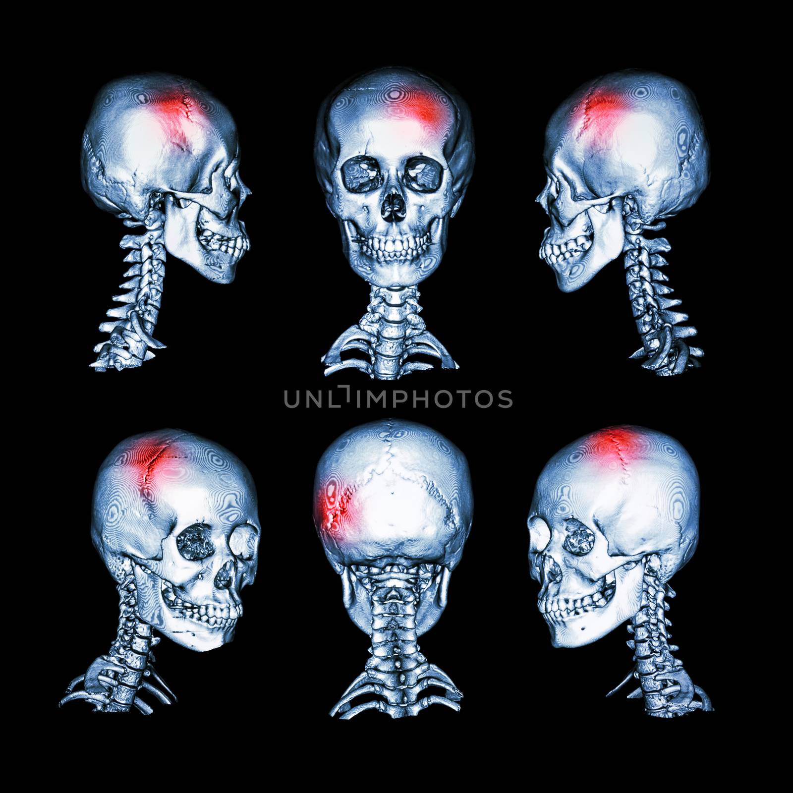 CT scan and 3D image of head and cervical spine . Use this image for stroke , skull fracture , neurological condition . by stockdevil
