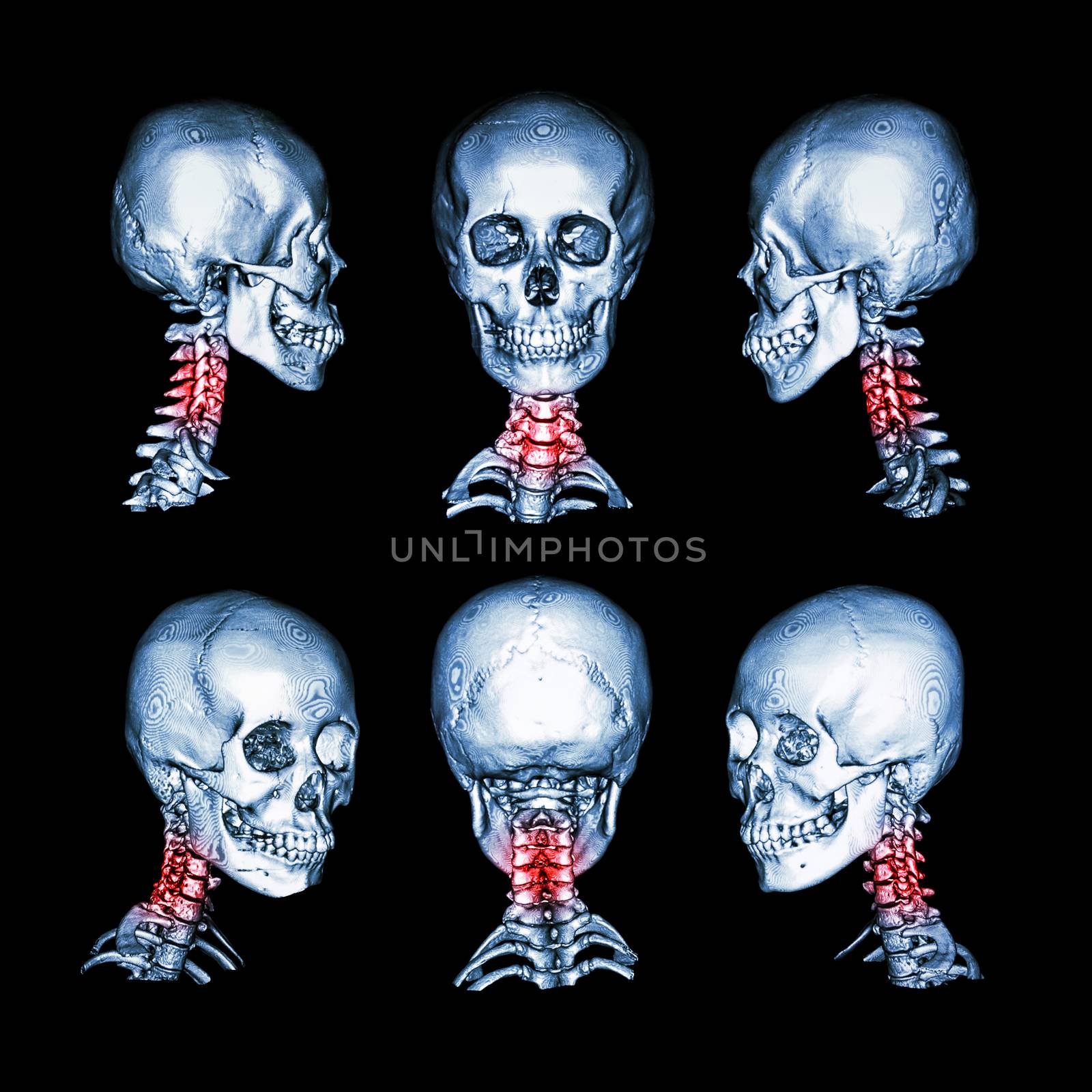CT scan and 3D image of skull and neck . Use this image for cervical spondylosis , spondylolisthesis , spondylitis , spine trauma condition . by stockdevil