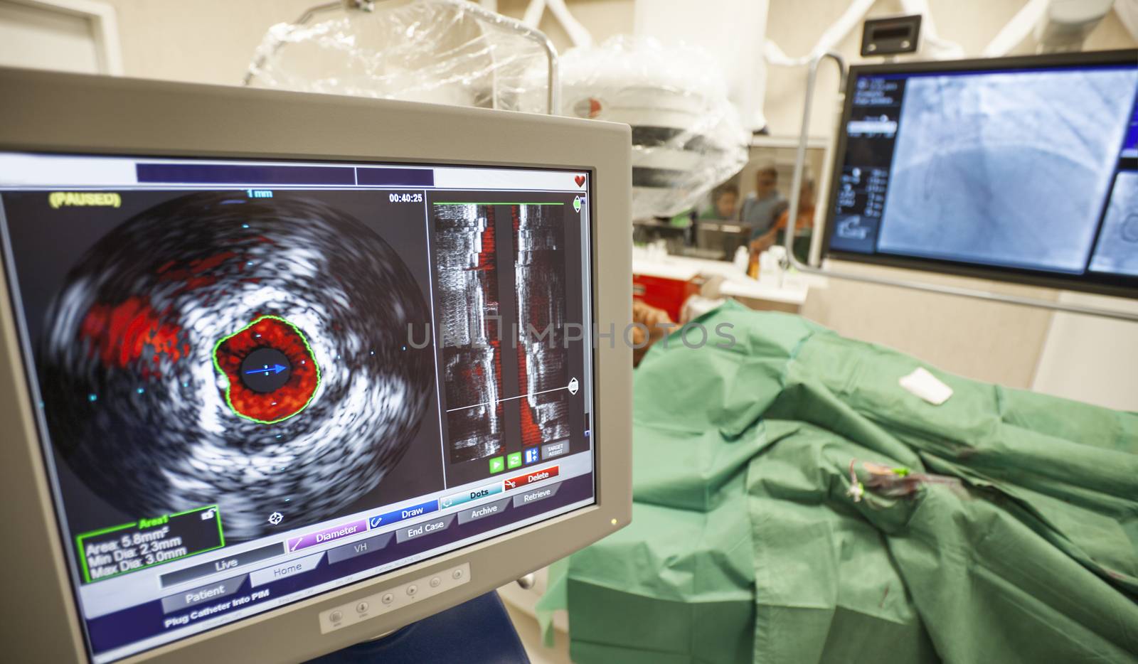 A monitor with an image of a blood vessel during laparoscopic surgery in modern hospital.