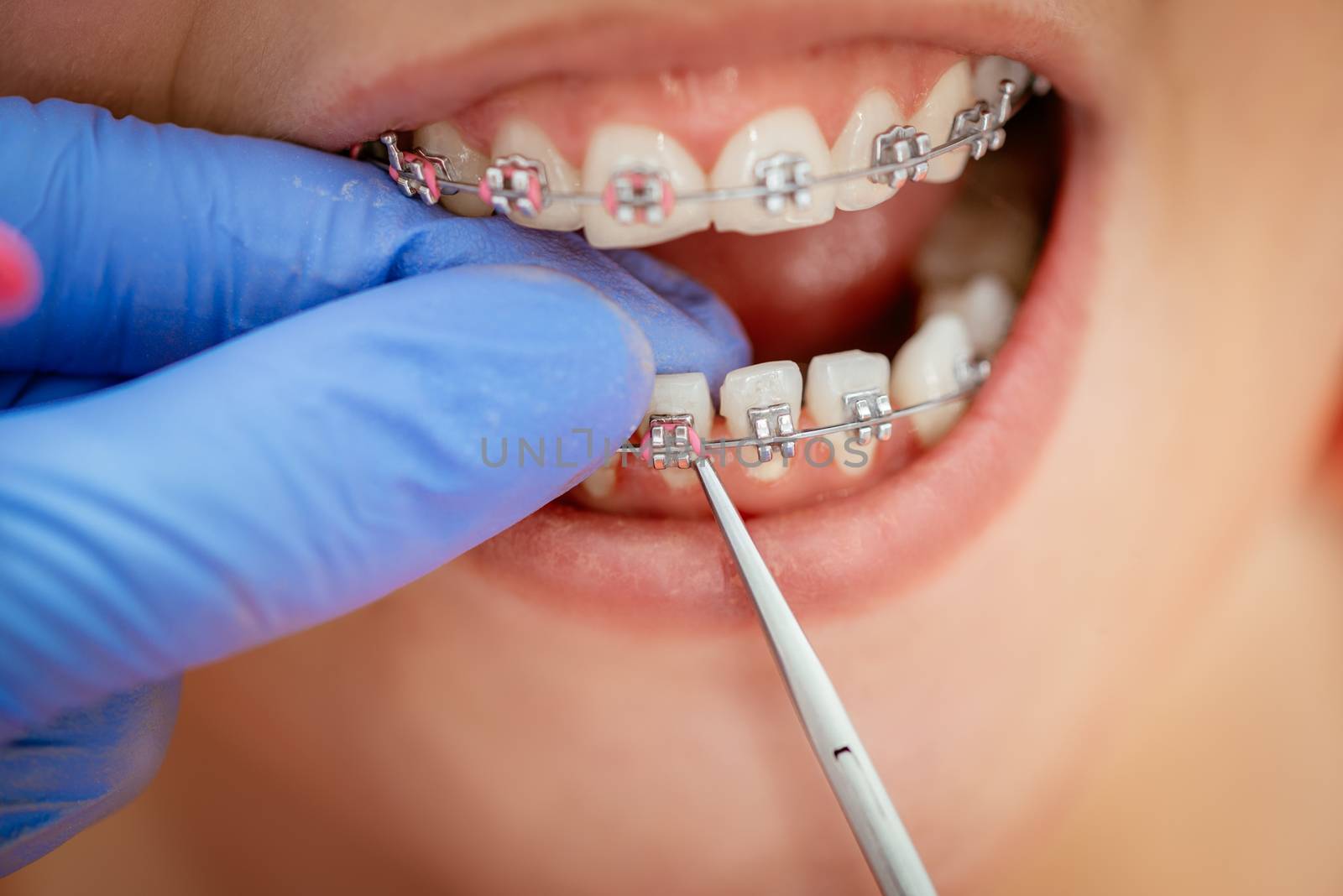 Dentist checking bracket at the braces on the female patient. Close-up. Real People.