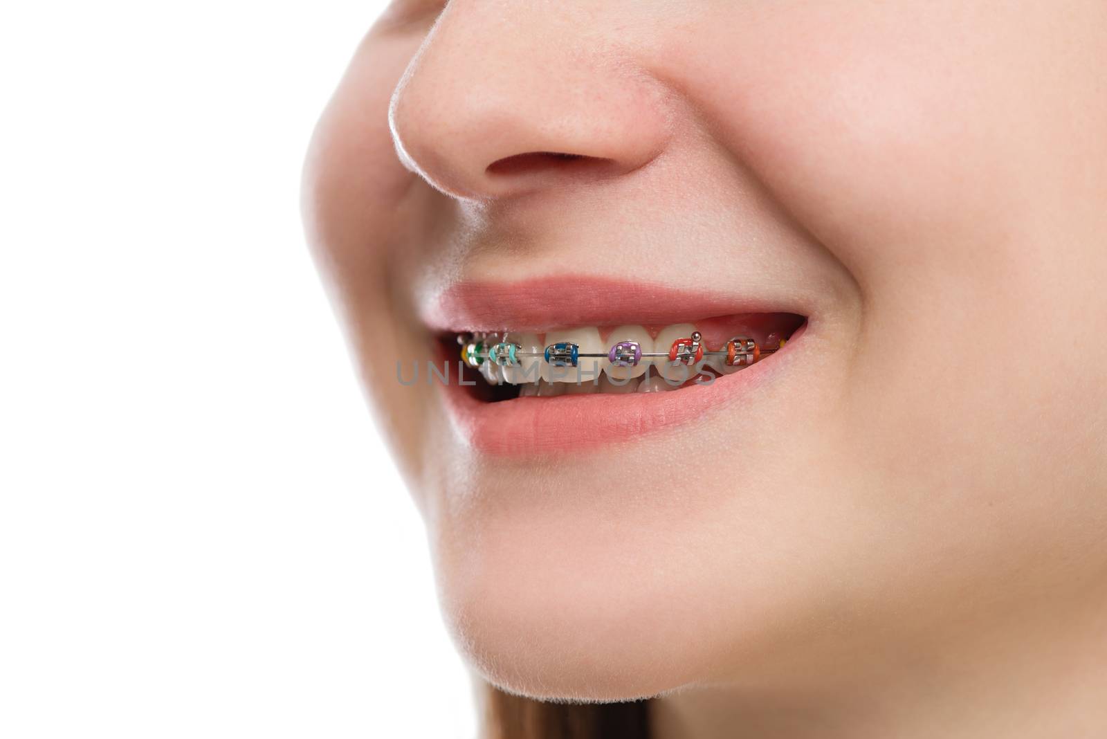 Closeup multicolored Braces on Teeth. Beautiful Female Smile por by Draw05