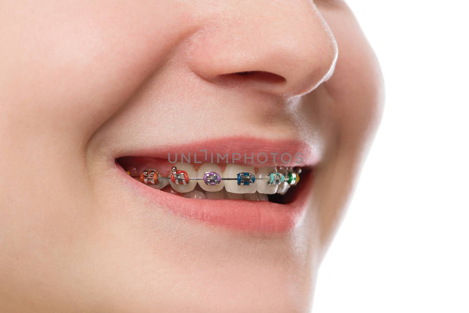 Closeup multicolored Braces on Teeth. Beautiful Female Smile portrait with Self-ligating Braces. Orthodontic Treatment.