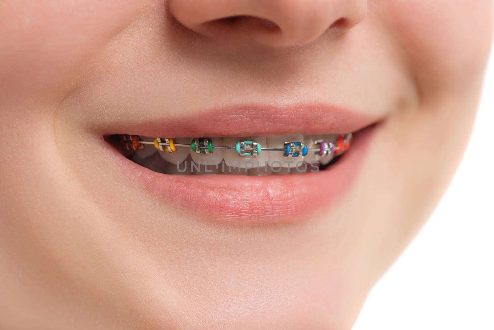 Closeup multicolored Braces on Teeth. Beautiful Female Smile wit by Draw05