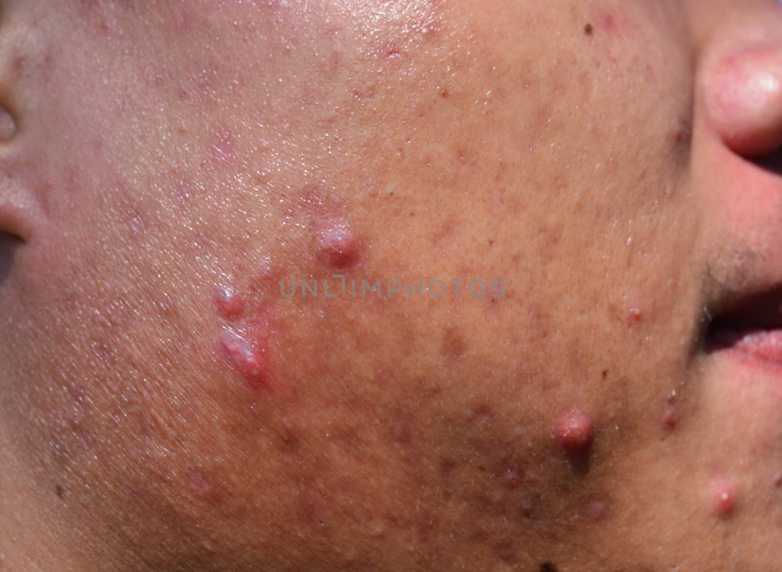 acne on skin face