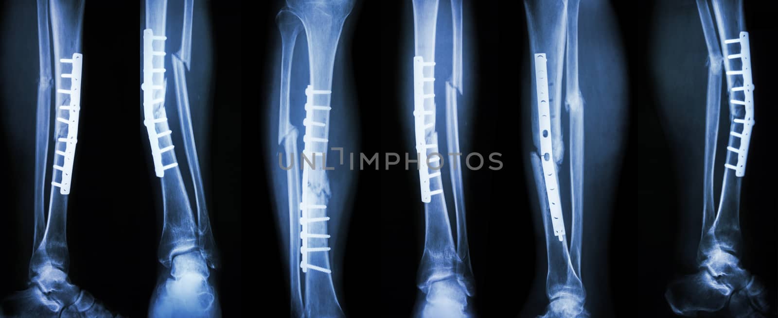 Collection image of leg fracture and surgical treatment by internal fixation with plate and screw . Break tibia and fibula bone .