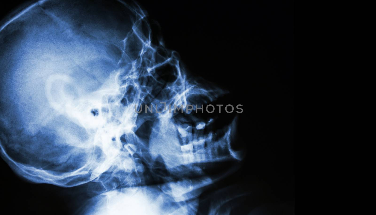 Film X-ray of normal human skull . lateral view . blank area at right side .