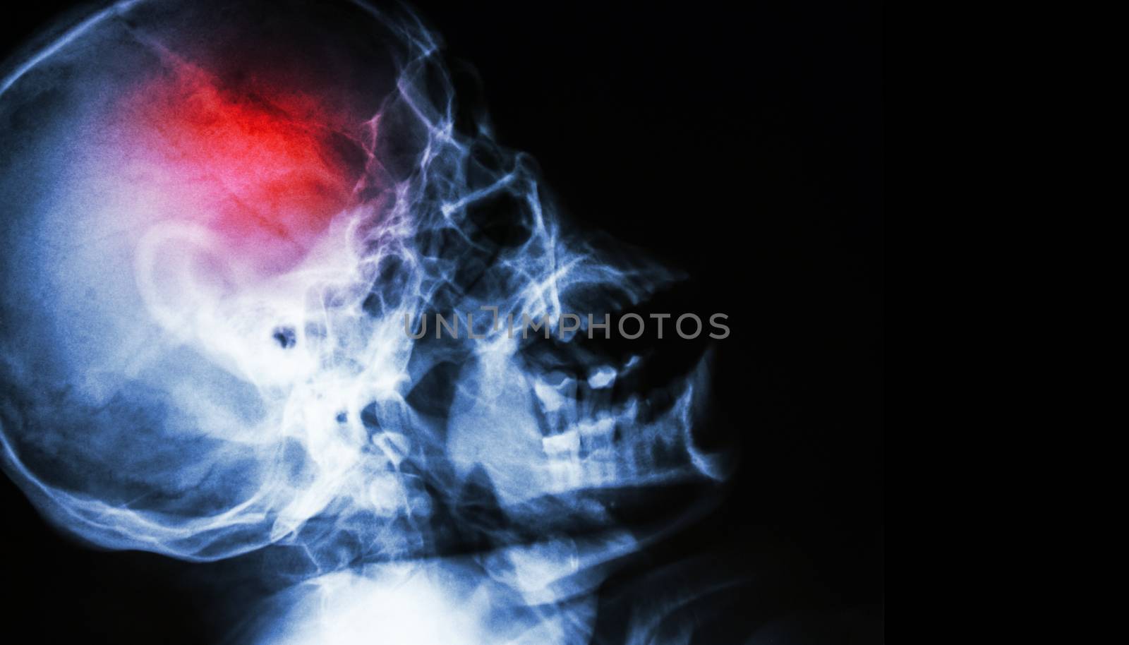 Stroke . film x-ray of human skull lateral view with stroke . blank area at right side . by stockdevil