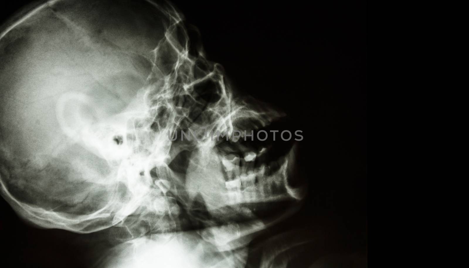 Film X-ray of normal human skull . lateral view . blank area at right side . by stockdevil
