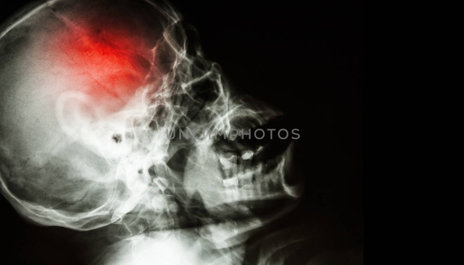 Stroke . film x-ray of human skull lateral view with stroke . blank area at right side .