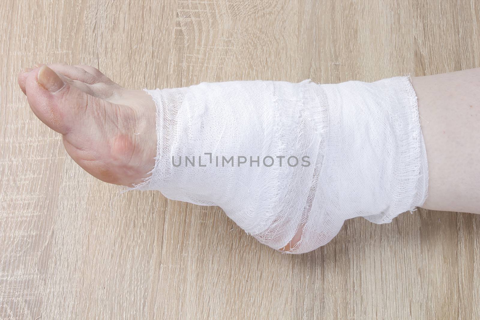 White medicine bandage on human injury foot