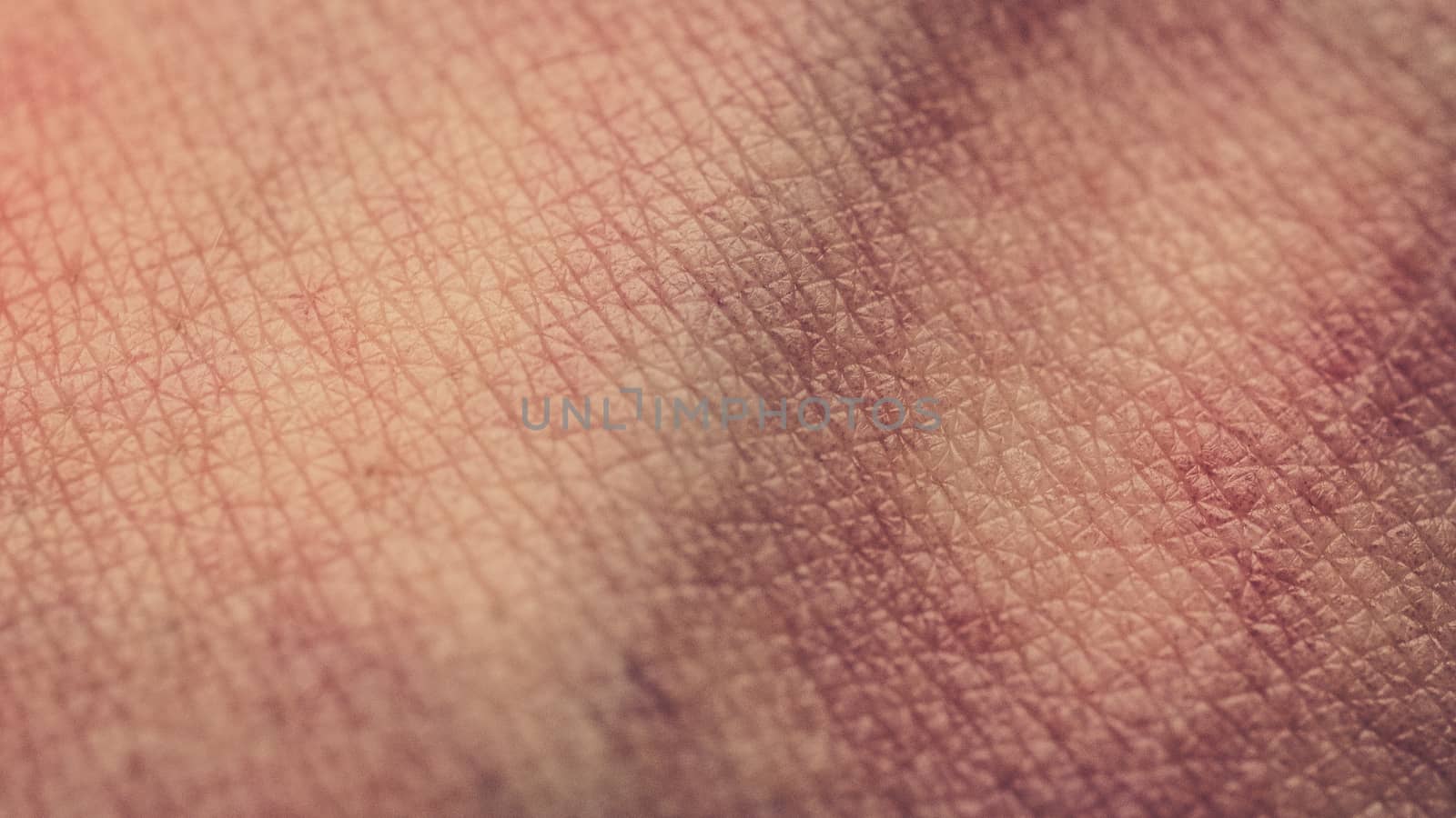 closeup of human skin, bruises, veins, skin texture