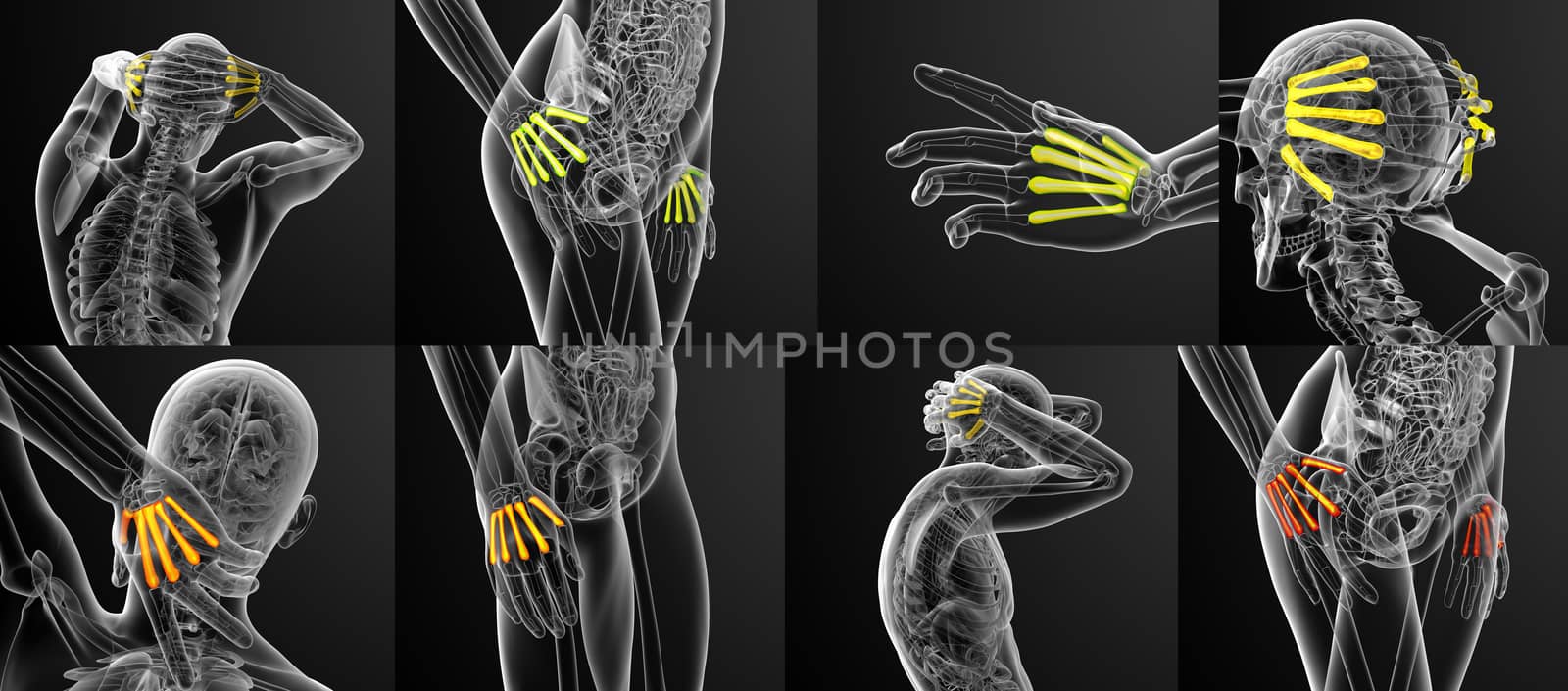 3d rendering medical illustration of the metacarpal bone 