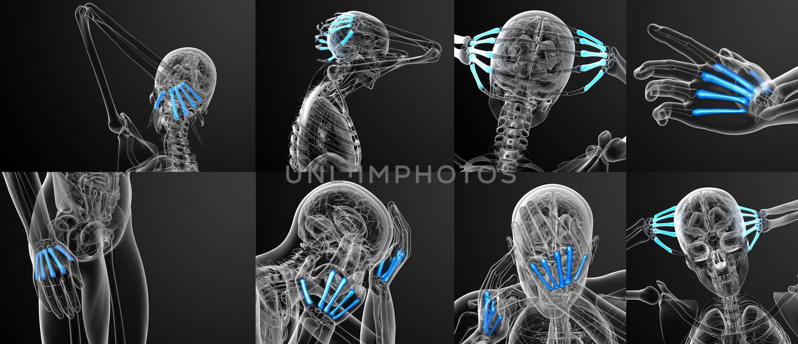 3d rendering medical illustration of the metacarpal bone 