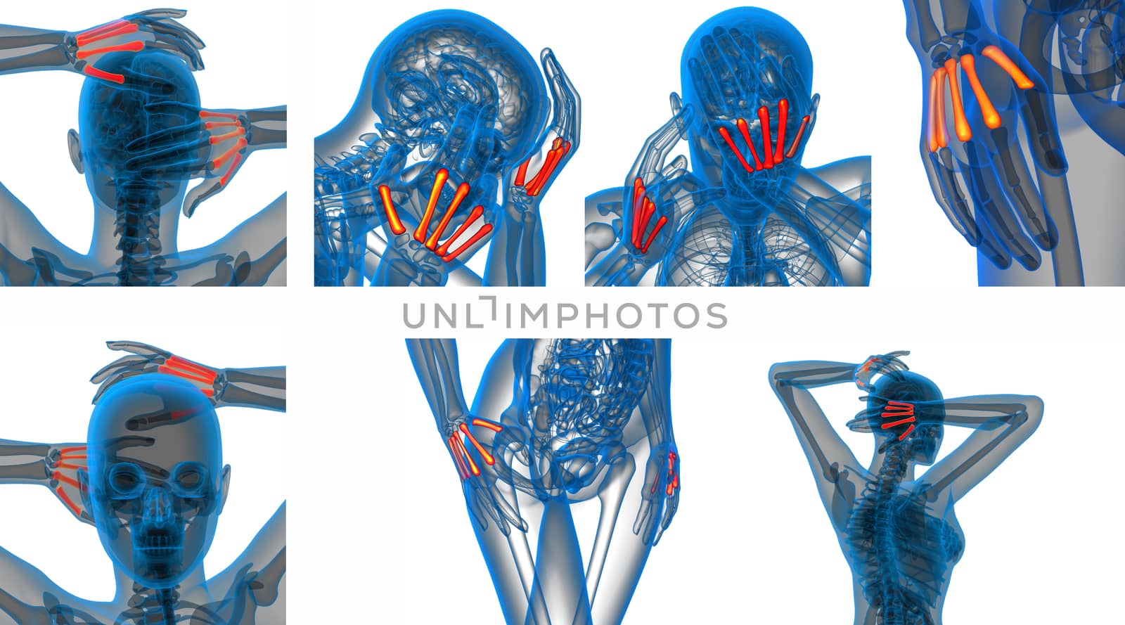 3d rendering medical illustration of the metacarpal bone 