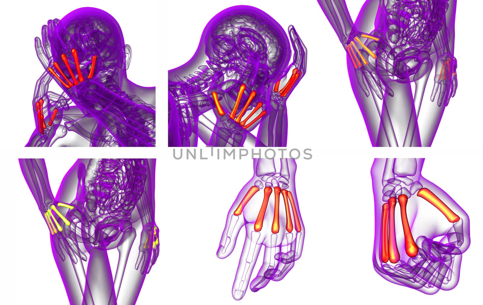3d rendering medical illustration of the metacarpal bone 