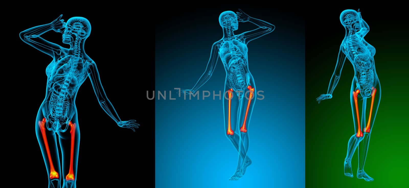 3d rendering medical illustration of the femur bone 