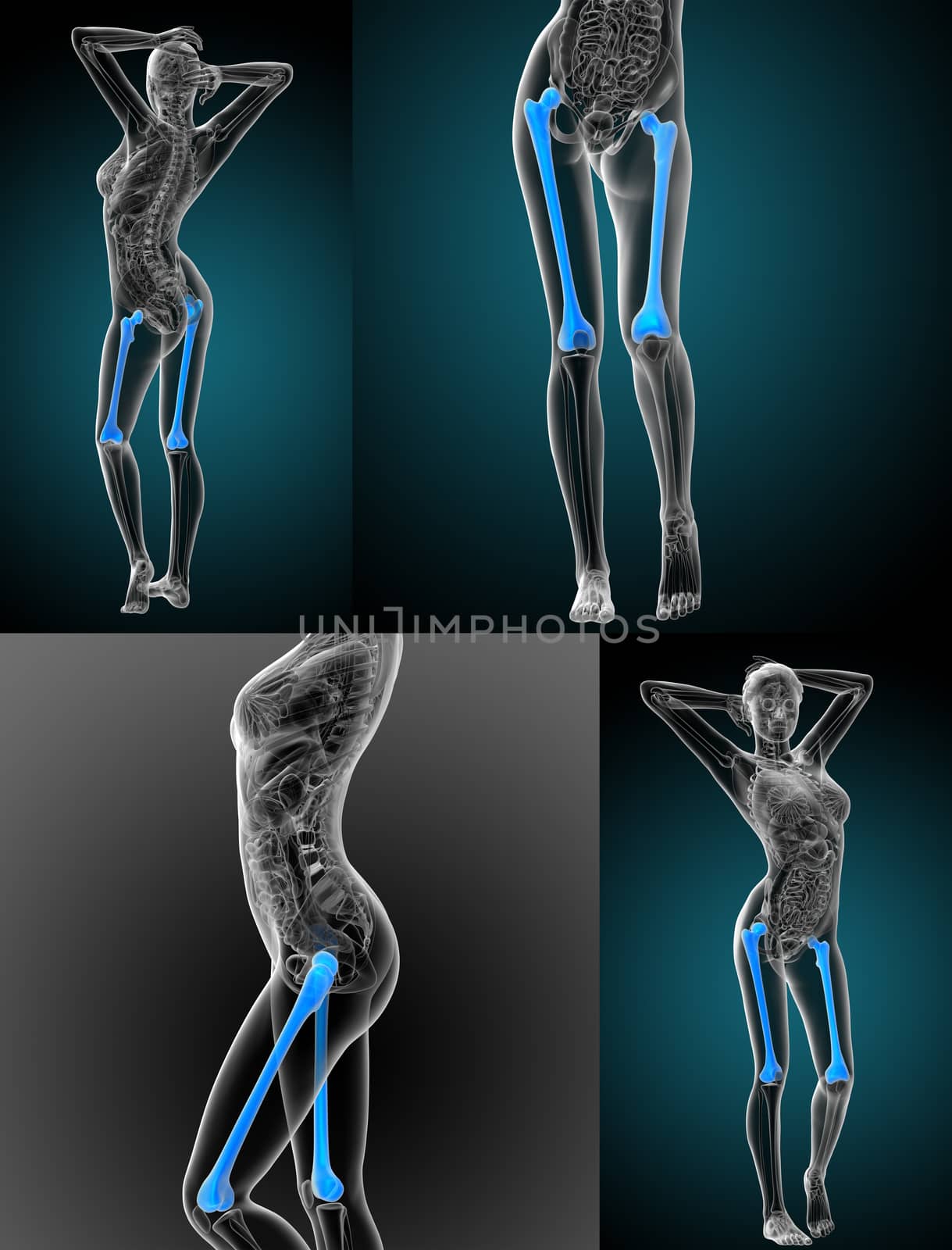 3d rendering medical illustration of the femur bone